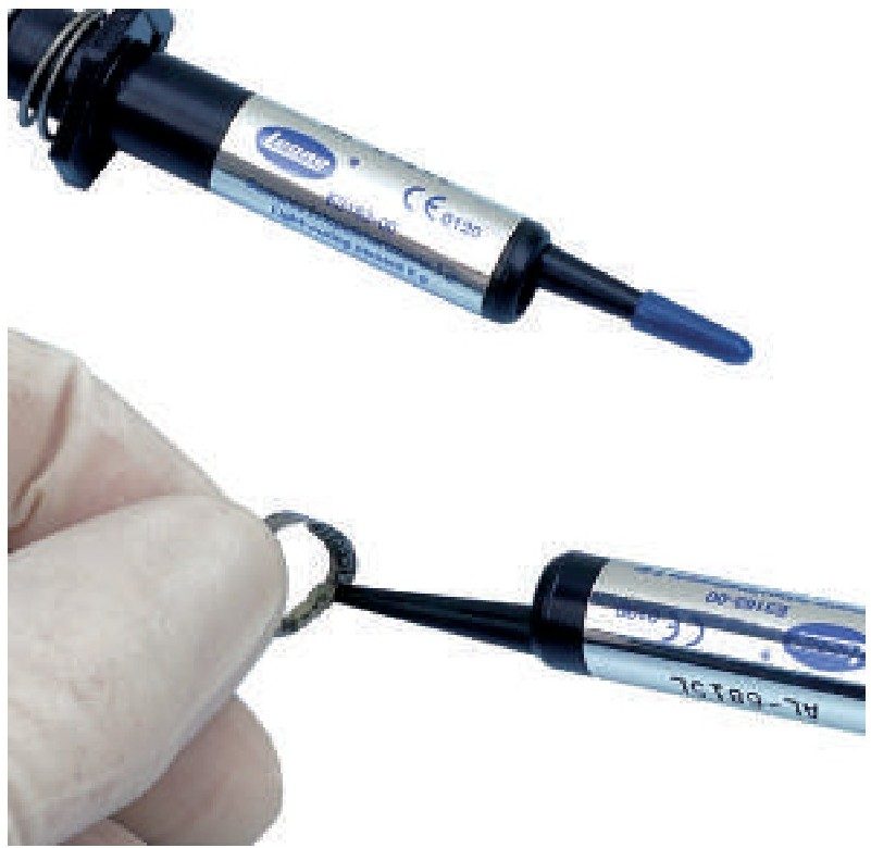 E3163-00 syringe application: the yellow shade shows excess before curing