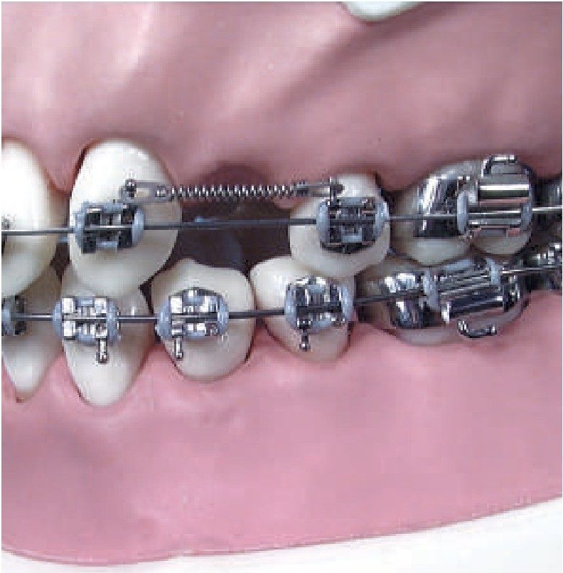 Spring under an elastomeric chain